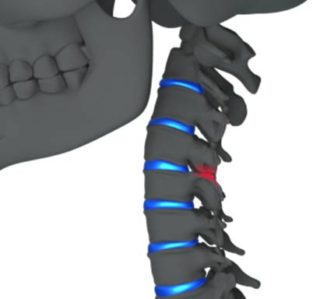 Cervical Facet Syndrome