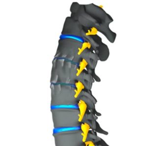 Cervical Spondylosis