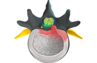 Lumbar Disc Herniation