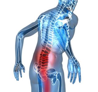 Lumbar Radiculopathy