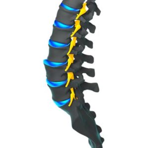 Lumbar Spondylolisthesis