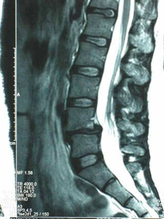 Risks Associated with MRI Scans