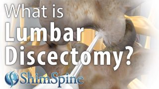 Why Lumbar Discectomy?