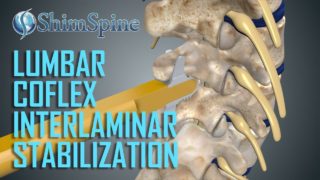 InterLaminar Decompression and Instrumentation