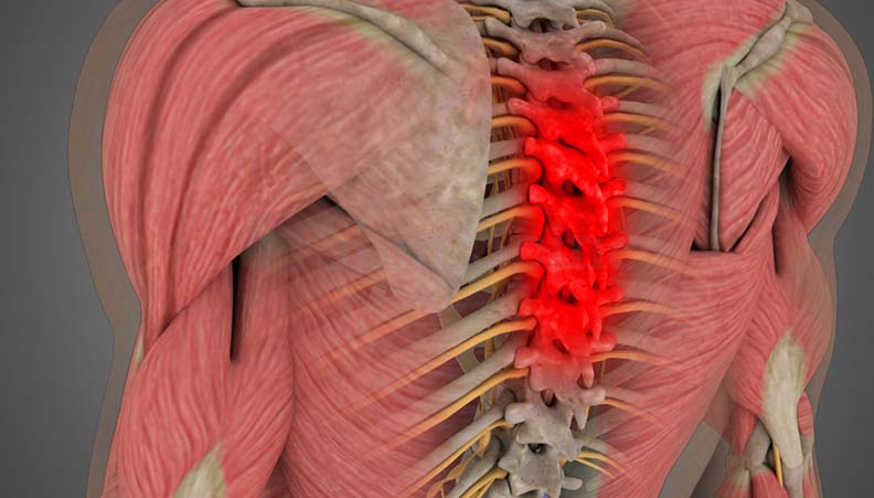 Thoracic Spinal Stenosis