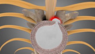 Thoracic Disc Herniation/Radiculopathy