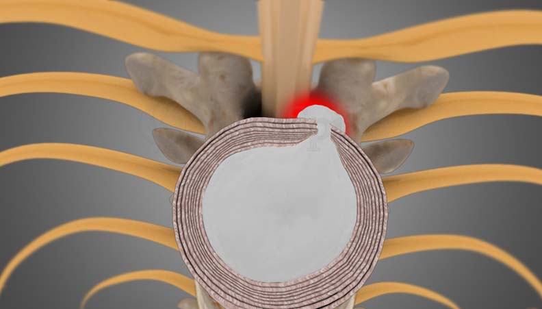 Thoracic Disc Herniation/Radiculopathy