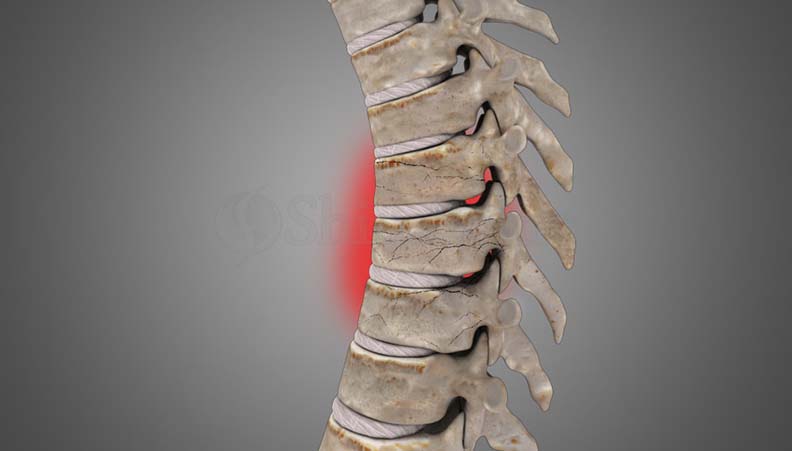 Spinal Compression Fracture