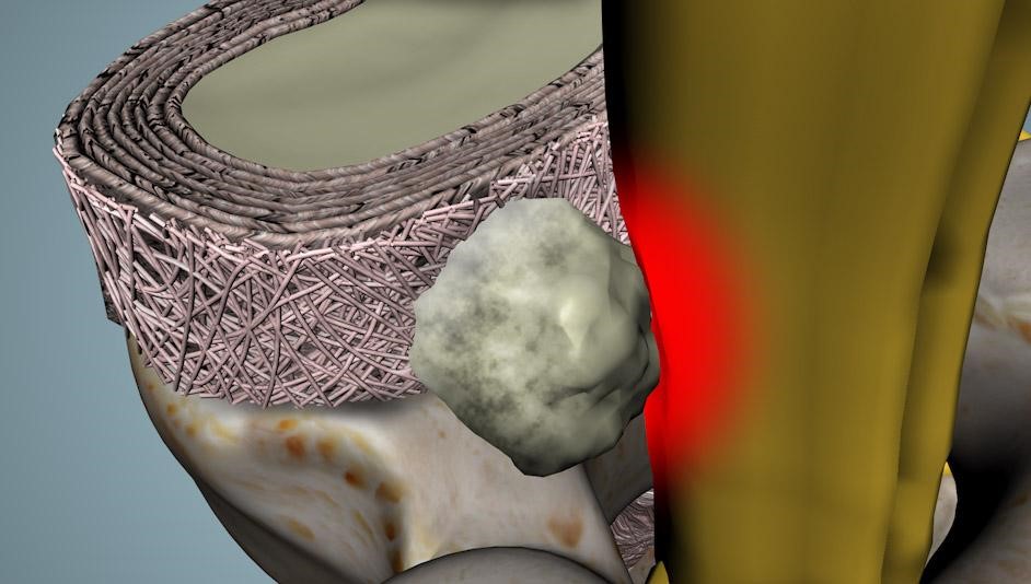 disc herniation