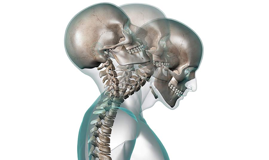 Whiplash, Cervical Strain, Cervical Sprain