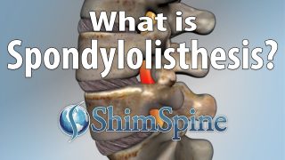 Spondylolisthesis