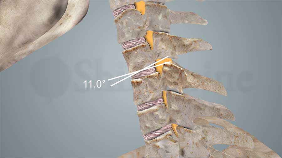 11 degrees comparing the flexion and extension views