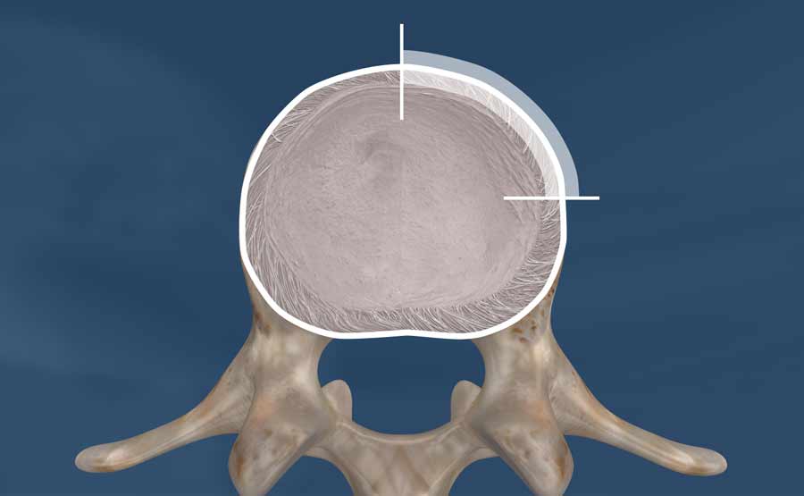 Focal or localized is defined by displacement that is less than 25% of the circumference of the whole disc.