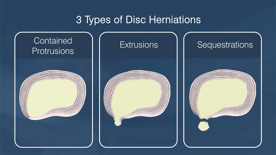 Three types of disc herniations