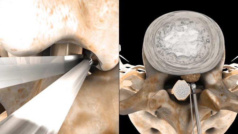 Does Discectomy Lead to Spinal Fusion? - ShimSpine
