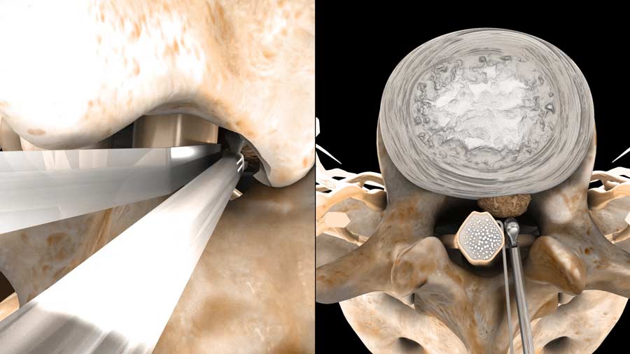 Spinal Fusion