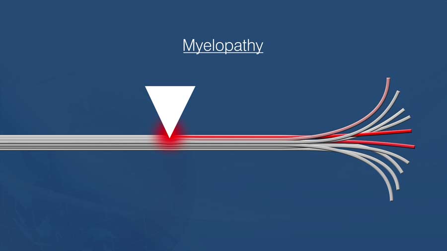 Myelopathy