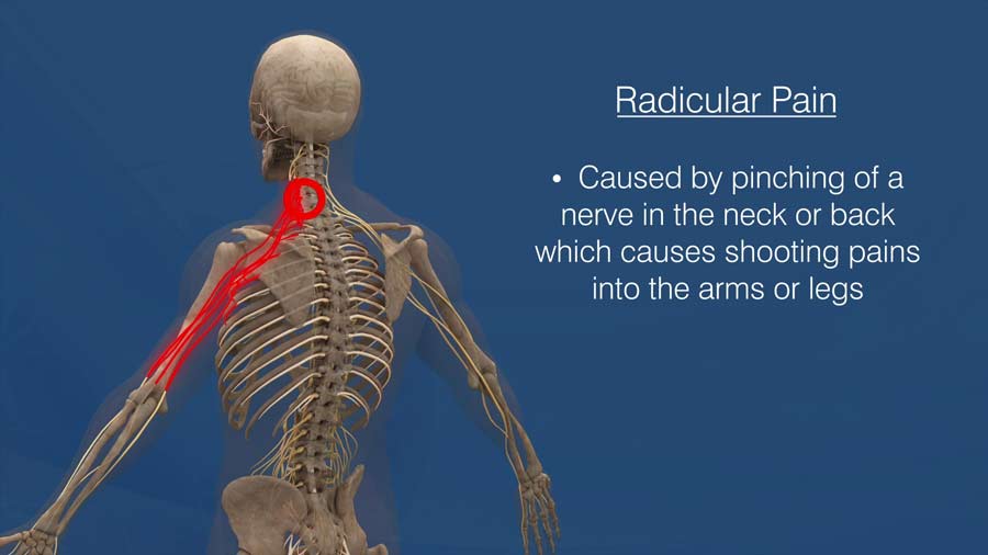 Radicular pain