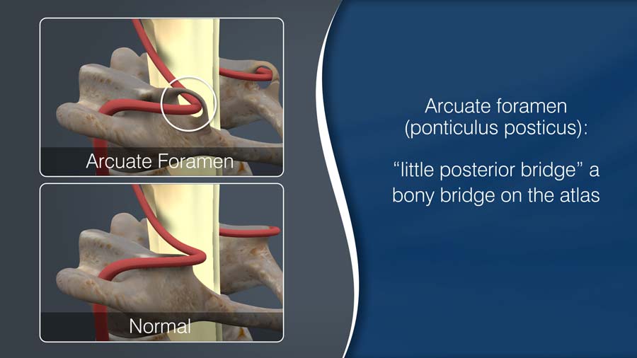 arcuate foramen