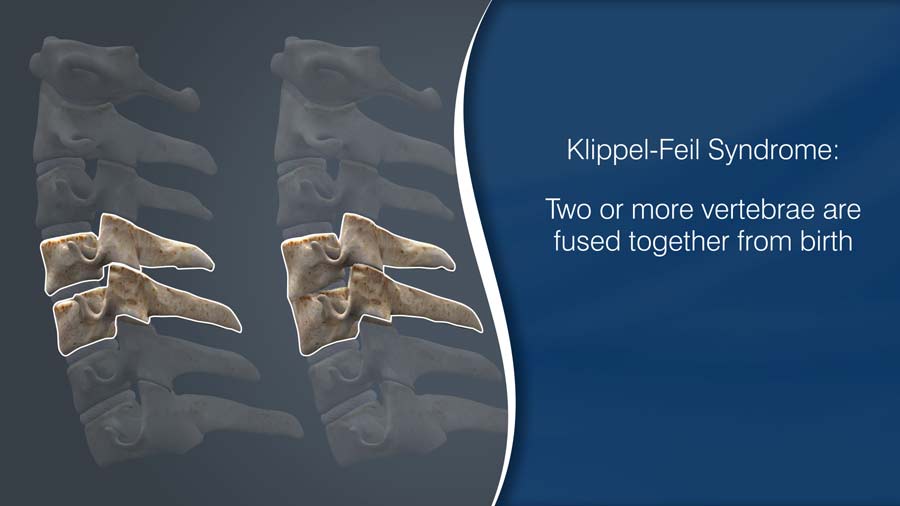 Klippel-feil syndrome