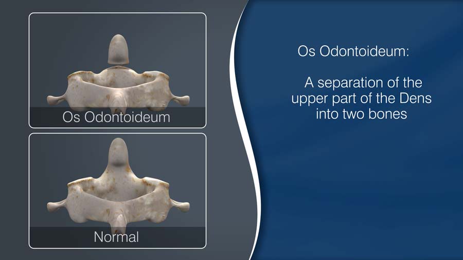 Os Odontoideum