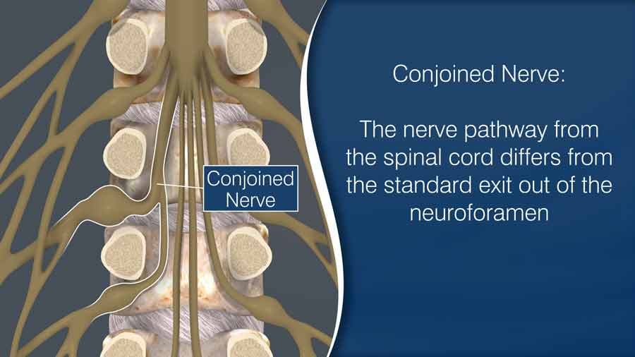 Conjoined nerve