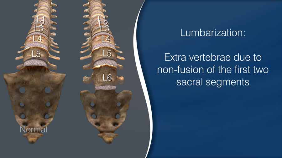 lumbarization of the Sacrum