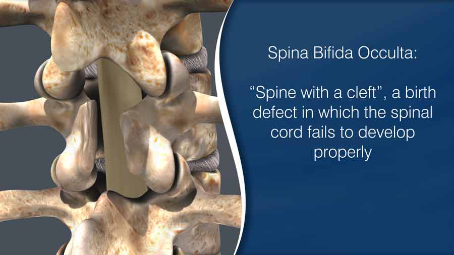 spina bifida occulta