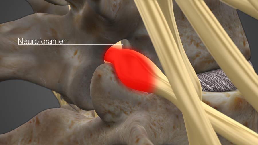 neuroforamen