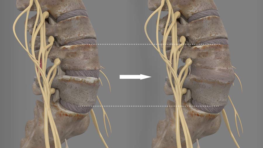 posterior lumbar fusion surgery