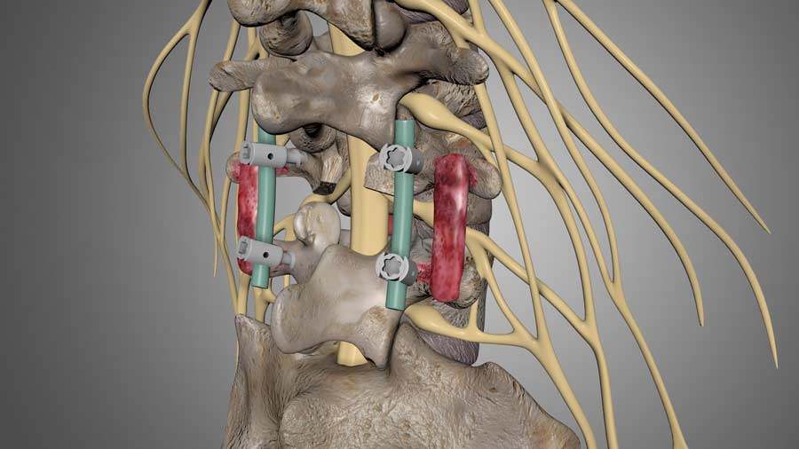 stabilization of the spine