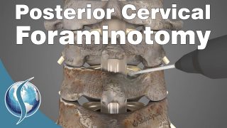 Posterior Cervical Foraminotomy