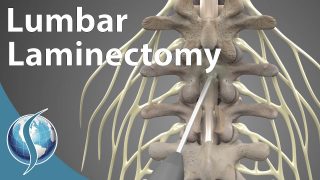 Lumbar Laminectomy