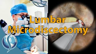 Lumbar Microdiscectomy