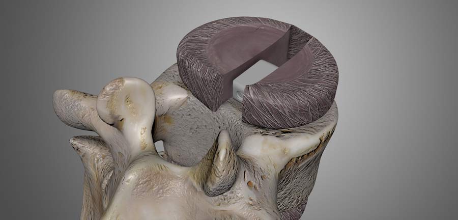 laminectomy procedure