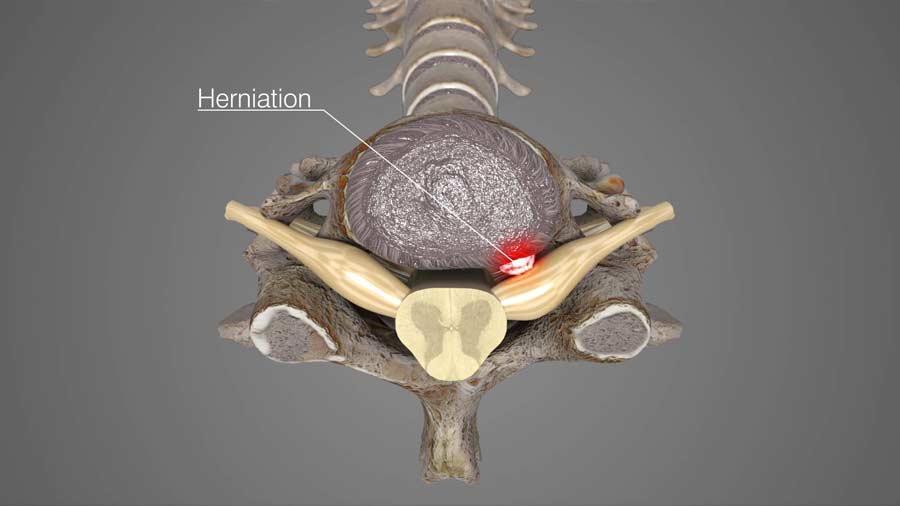 disc herniation