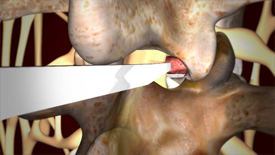 Lumbar Microdiscectomy