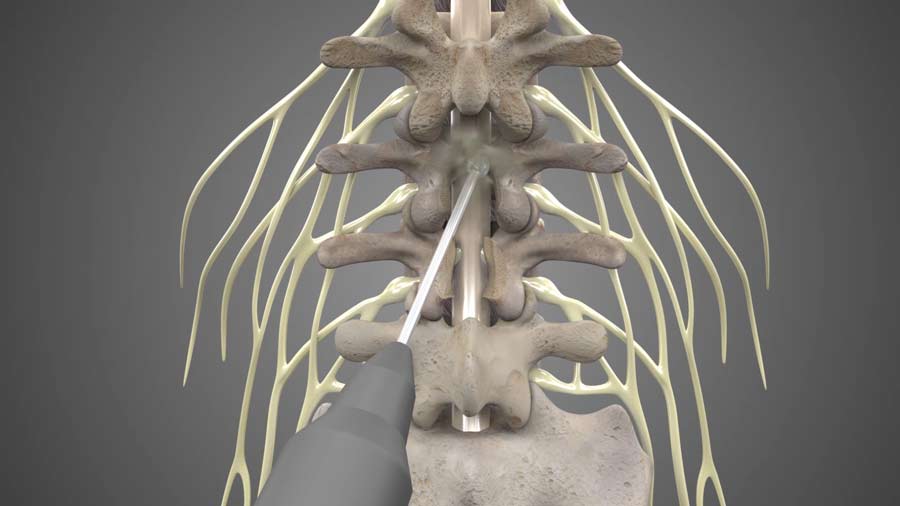 Lumbar Laminectomy