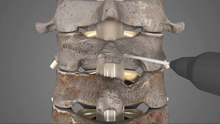 Removing excess bone