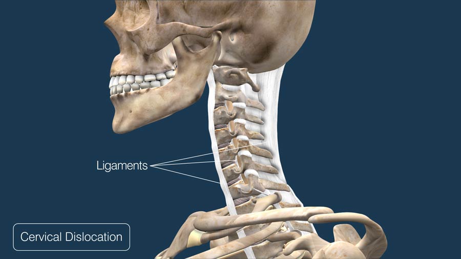 Cervical Dislocation