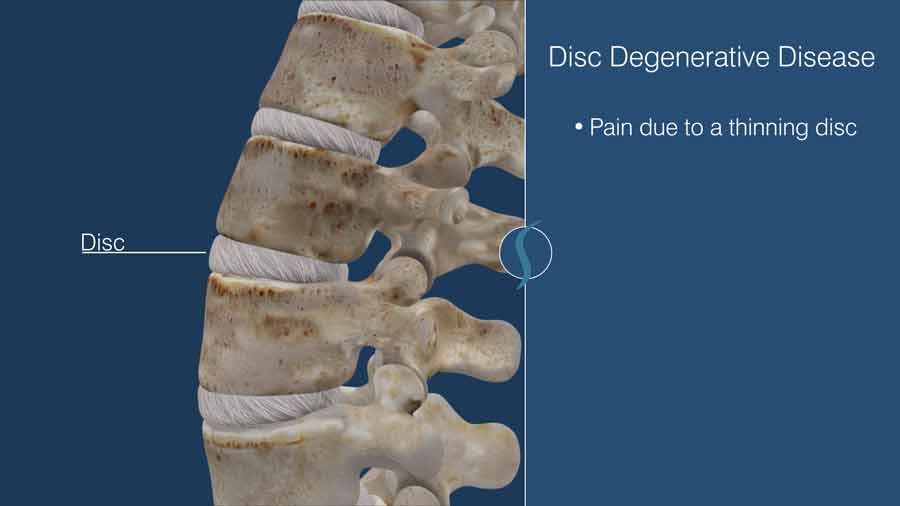 Disc degenerative disease