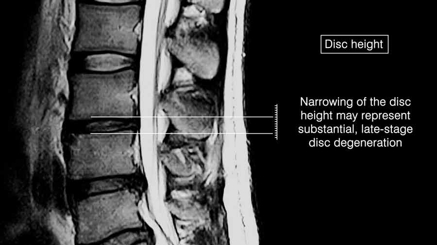 disc height