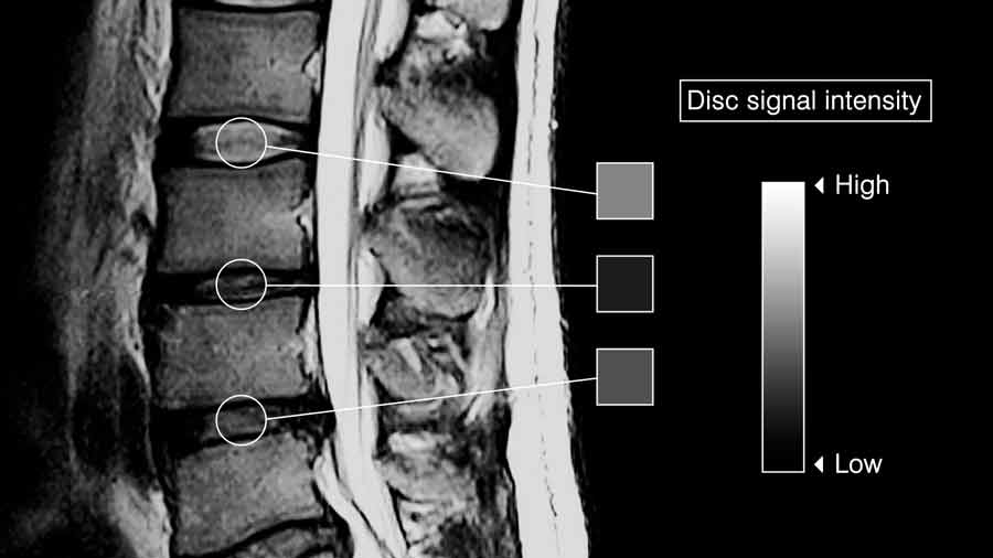 disc signal intensity