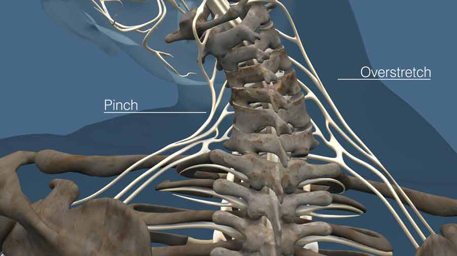 Overstretching and pinching