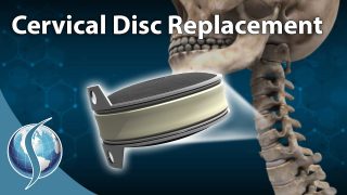 Artificial Cervical Disc Replacement
