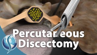 Is Percutaneous Discectomy Better Than Traditional Discectomy?