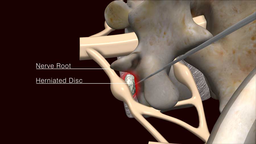 removal of the herniated disc material