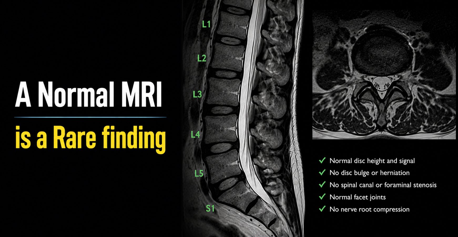 A Normal Lumbar MRI Is a Rare Finding for Anyone Older Than 40